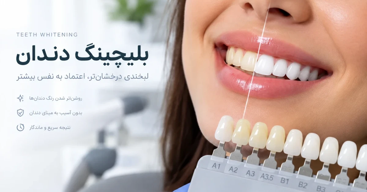 بلیچینگ دندان؛ راهی مطمئن برای سفید کردن و روشن‌تر شدن لبخند